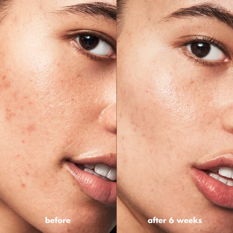 e.l.f Blemish Breakthrough Fighting Spot Gel