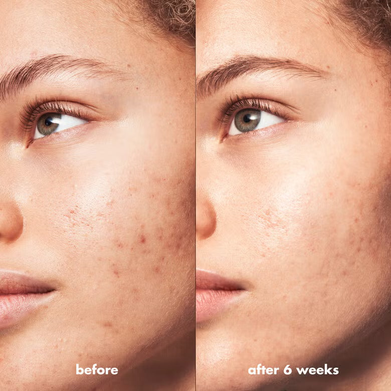 e.l.f Blemish Breakthrough Fighting Spot Gel